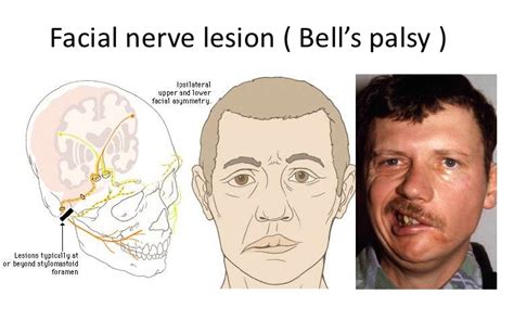 Bells Palsy At Emaze Presentation