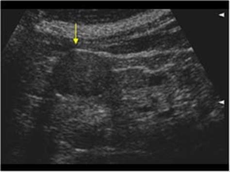 Oncocytoma Longitudinal Ultrasound Reproductive System Renal