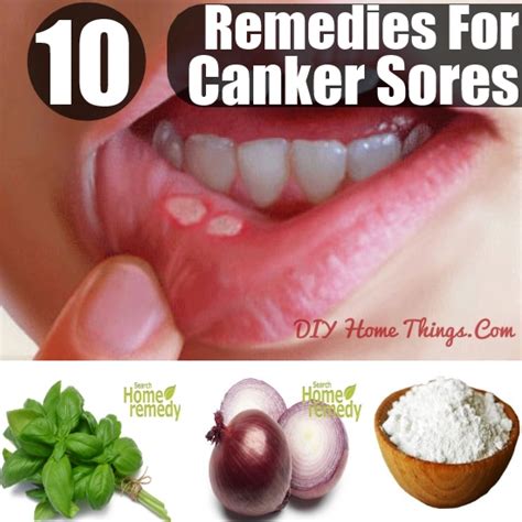 10 Easy Home Treatments For Canker Sores Diy Home Things