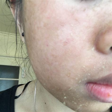 Extremely Red Dry Peeling Skin And Dark Patch With Picture The