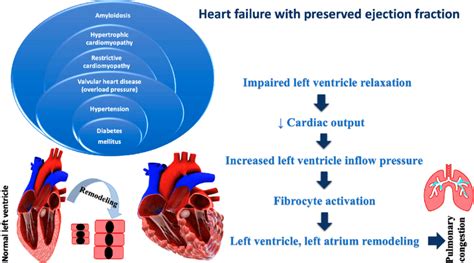 Pathophysiology Of Heart Failure With Preserved Ejection Fraction
