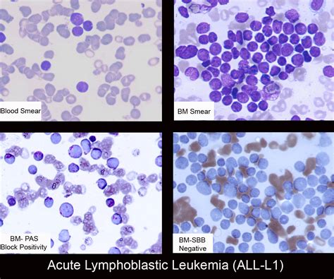 Acute Lymphoblastic Leukemia T Cell Modification As Leukemia Treatment