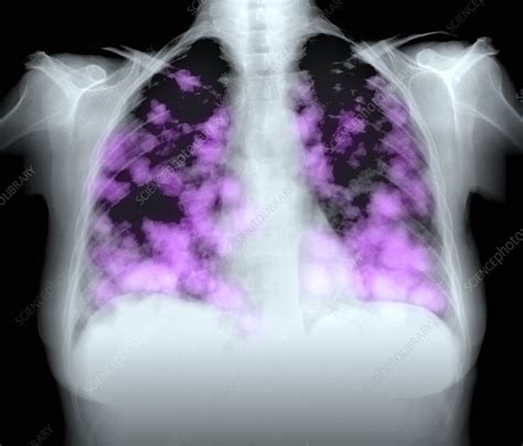 Secondary Lung Cancers X Ray Stock Image M1340506 Science Photo