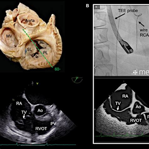 Right Ventricular Rv Inflow Outflow Tract View As Seen In