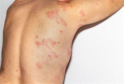 Rash Caused By Lamictal May Be A Sign Of Drug Induced Hypersensitivity