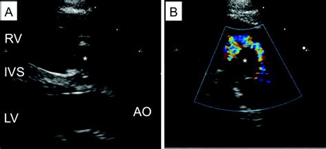 Dynamic Right Ventricular Outflow Tract Obstruction Due To A Swinging