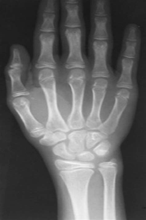 Hand Wrist Radiograph Download Scientific Diagram