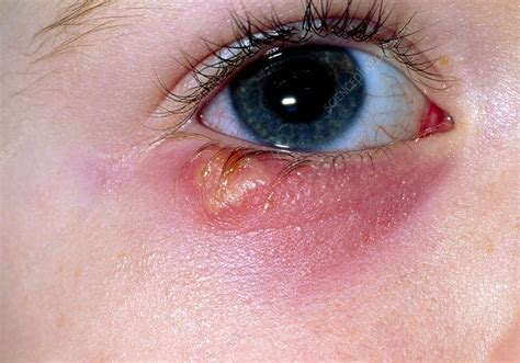 Herpes Simplex Eyelid Treatment Herpes Simplex Keratitis And Herpes