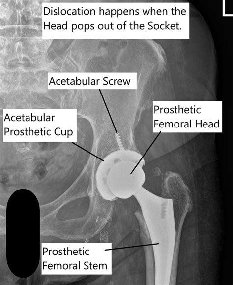 Total Hip Joint Dislocation Complete Orthopedics Multiple Ny Locations