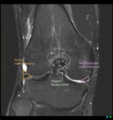 Bucket handle meniscus tears are more common in younger athletes. Bucket handle medial meniscus tear | Radiology Case ...