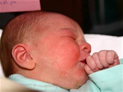 Can breastfeeding babies have milk allergy? Milk Allergy Symptoms in Breastfed Babies - How To Recognize?