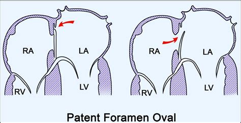 Patent Foramen Ovale A New Disease International Journal Of Cardiology