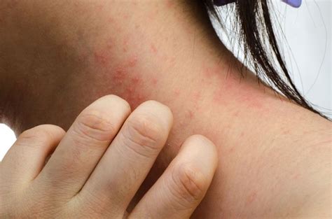 The Sneaky Things Causing Your Scalp To Itch And Flake Scaly Skin