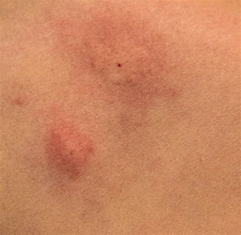 Mosquito Bites Swelling