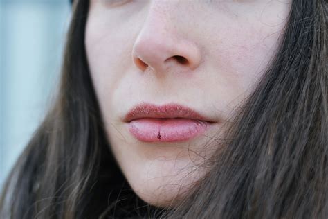 What Causes The Inside Of Your Lips To Be Raw Sitelip Org