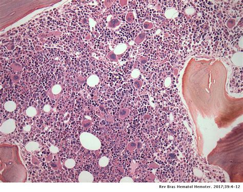 Secondary Myeloid Neoplasms Bone Marrow Cytogenetic And Histological