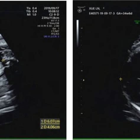 Antenatal Ultrasound Scan At 36 5 Weeks Gestation And An Ultrasound