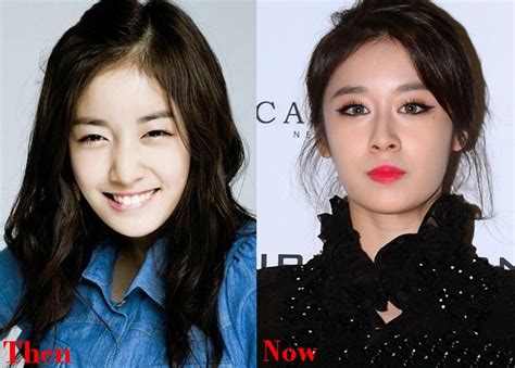 Snsd Tiffany Before And After Surgery