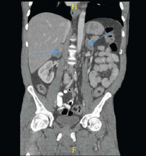 A Ct Abdomen And Pelvis With Iv Contrast Showing Bilateral Adrenal