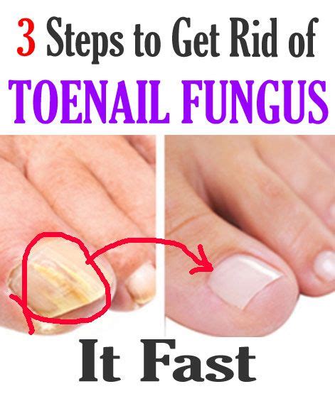 47 Cool Natural Home Remedies For Toe Fungus Home Decor Ideas