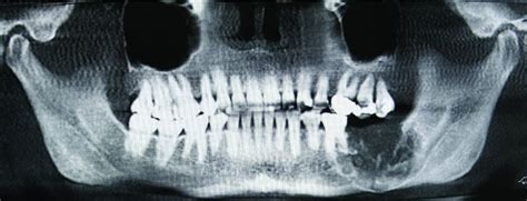 45 Benign Tumors Of The Jaws Pocket Dentistry