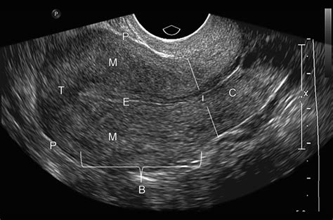 transvaginal ultrasound of the uterus note the uterine fundus f download scientific diagram