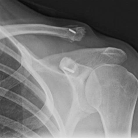 Acromioclavicular Joint The Other Joint In The Shoulder Ajr