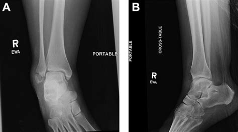 Fracture Through A Distal Fibular Tunnel Used For An Anatomic Lateral