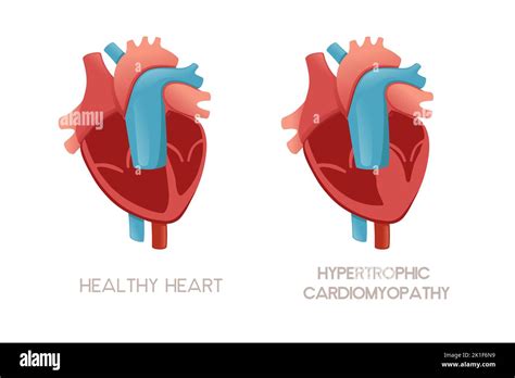 Healthy Human Heart And Heart With Hypertrophic Cardiomyopathy Disease