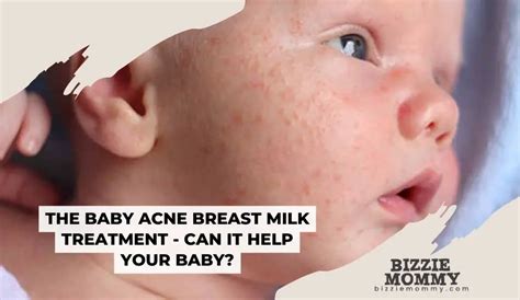 The Baby Acne Breast Milk Treatment Can It Help Your Baby Bizzie Mommy