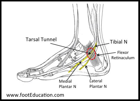 Tarsal Tunnel Syndrome Orthopaedia Foot And Ankle