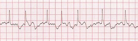 Atrial Fibrillation With Lbbb Ekg Examples Wikidoc Vrogue Co