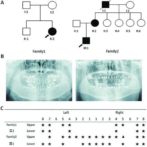 Identification Of Two Chinese Families With Non Syndromic Tooth