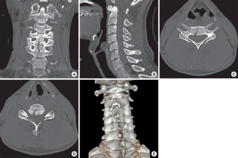 Cervical Spine Computed Tomographic Ct Scans With 3 D Open I