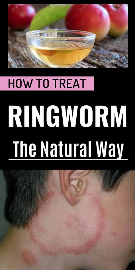 How To Treat Ringworm The Natural Way Get Rid Of Ringworm Ringworm