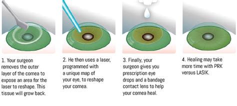Prk Procedure Welcome To Eyecare Associates Of South Tulsa