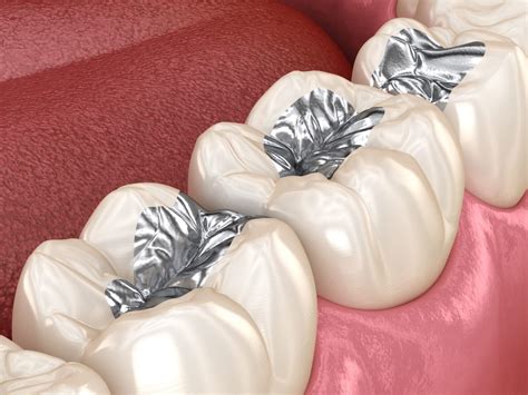 Black Spots Inside My Mouth 3d Dentistry In Bradenton Fl