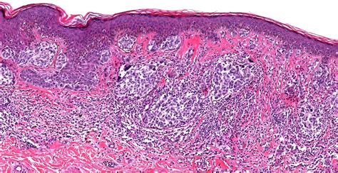 Pathology Outlines Invasive Melanoma