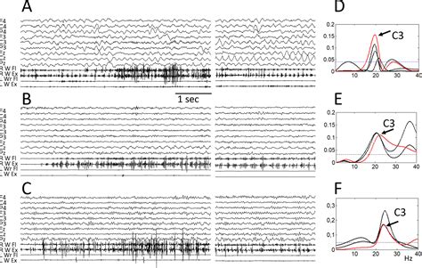 Rhythmic Cortical Myoclonus In Patients With 6q221 Deletion European