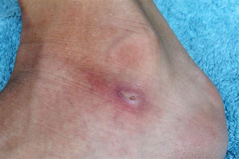 Circles Of Dead Skin On Feet Facial Scrub