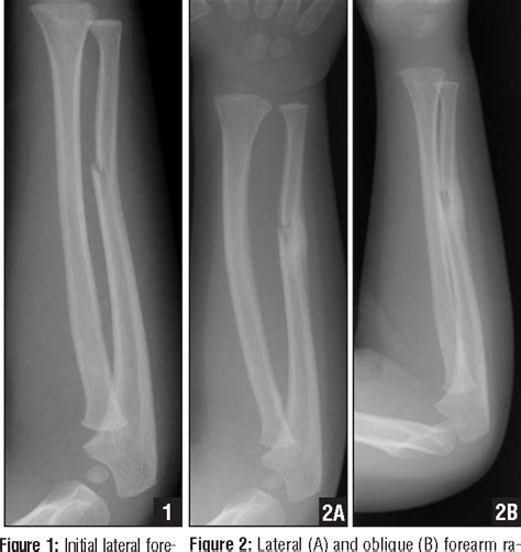 Pdf Ulnar Fracture With Late Radial Head Dislocation Delayed