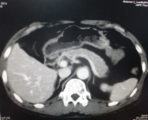 Vietnamese Medic Ultrasound Case 206 Epigastric Mass Post