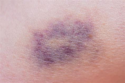 Anemic Bruise