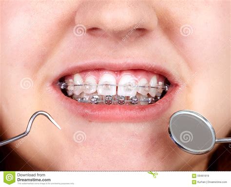 Teeth With Orthodontic Brackets Stock Image Image Of Dentist Mouth 59461919