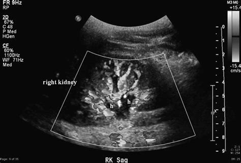 Saggital View Of The Kidney With Color Doppler Areas Of Low Grade