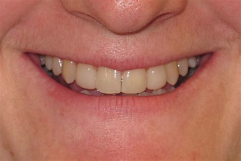 Cosmetic Bonding Smile Gallery Raber Dental Kidron Dentist
