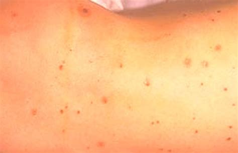 Meningitis Symptoms Treatment Causes Rash Pictures Hubpages
