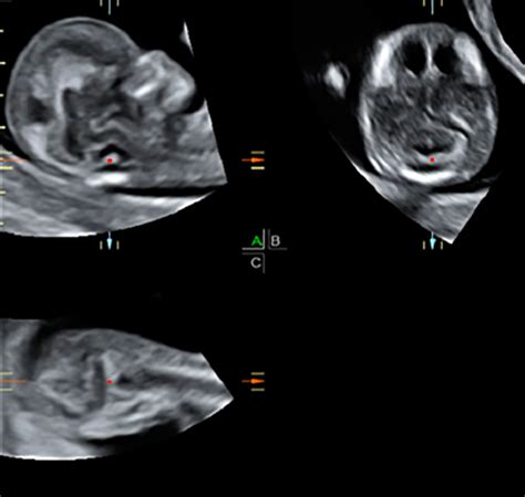 4th Ventricle Fetal Ultrasound