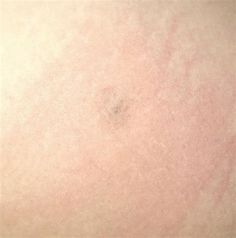 Brown Recluse Bite Photo Timeline Update Weeks 5 10 Rpopping