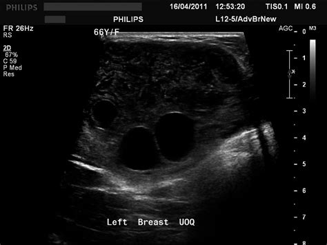 Target Ultrasound Image Of The Left Breast Upper Outer Quadrant Shows A
